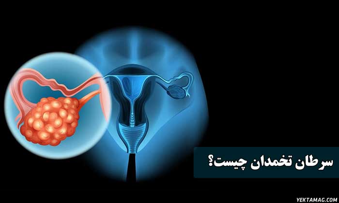 سرطان تخمدان چیست